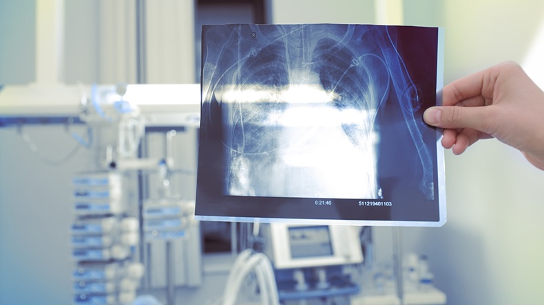 Silicosis (sfam_photo/Shutterstock.com)